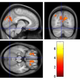 Illustration for article titled Brain-Hacking May Cure Tourettes — Or Weaponize It